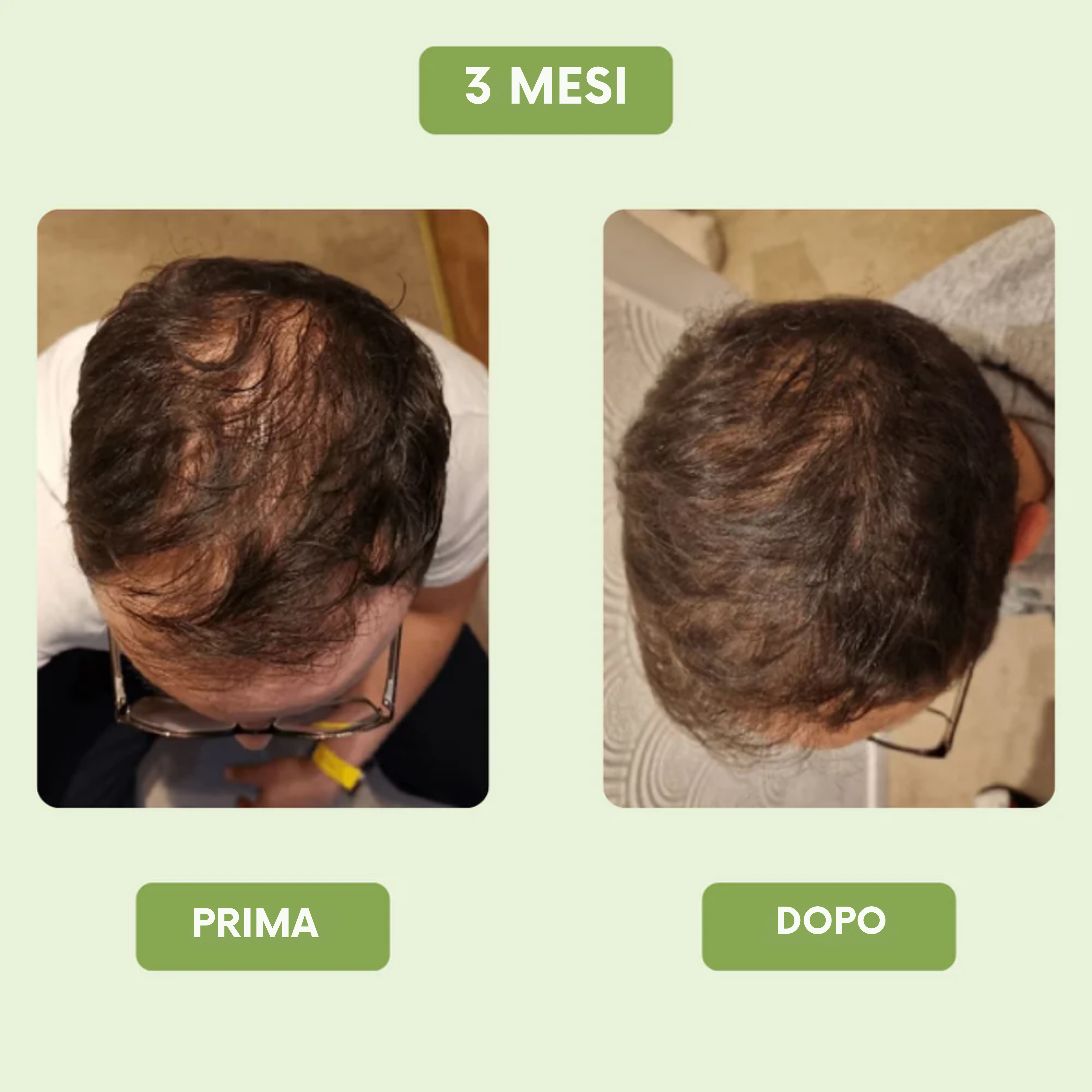 Siero di crescita capillare per uomini