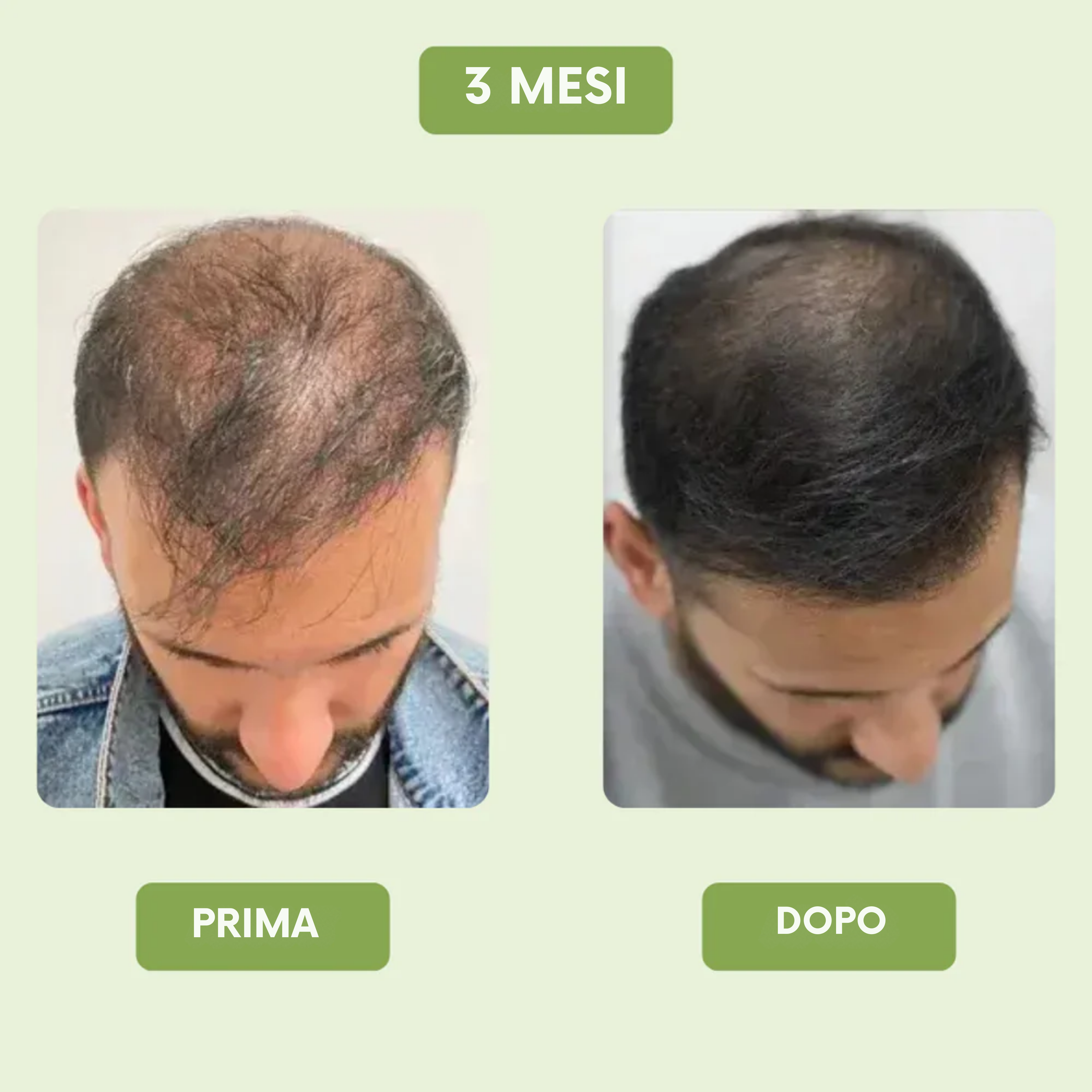 Siero di crescita capillare per uomini