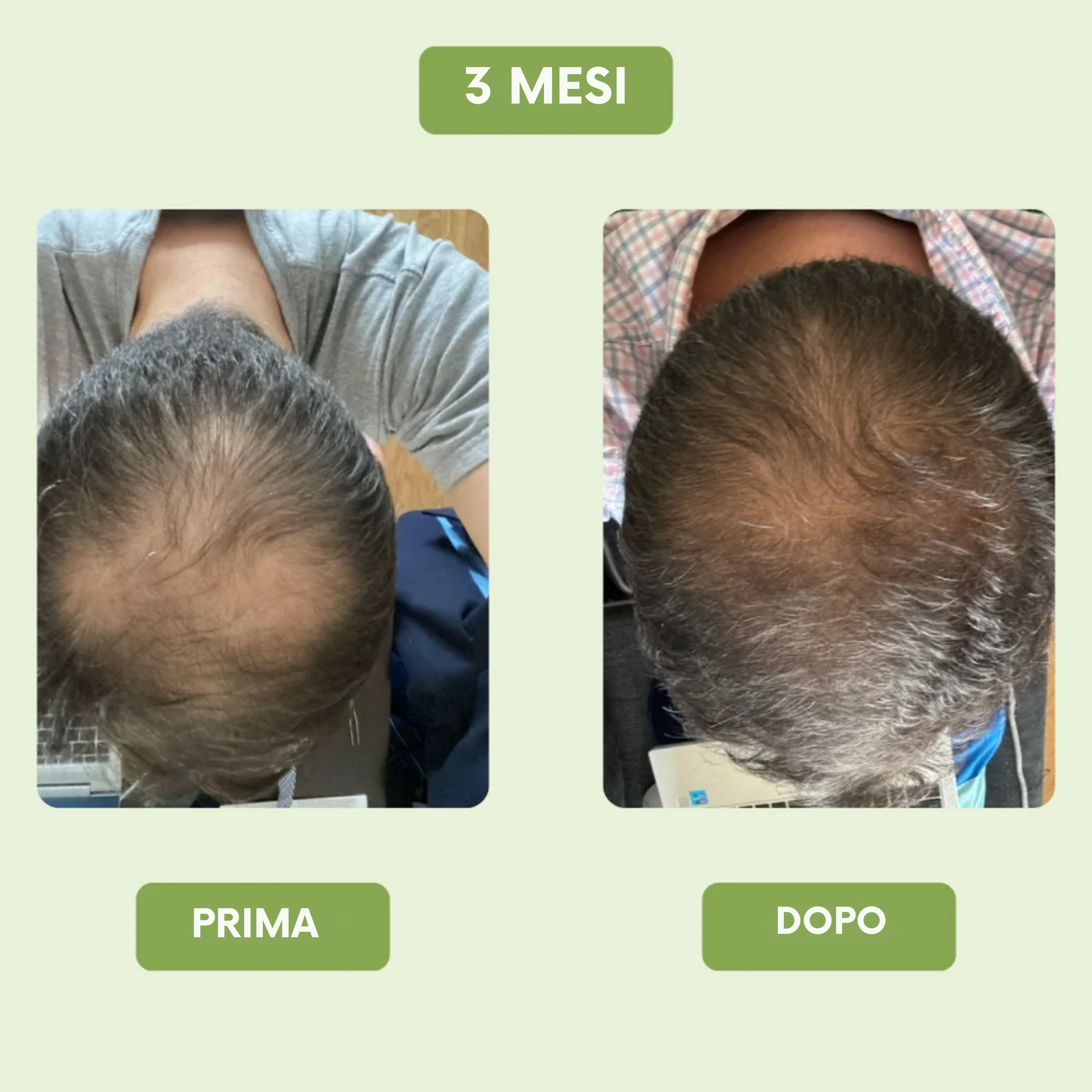 Siero di crescita capillare per uomini